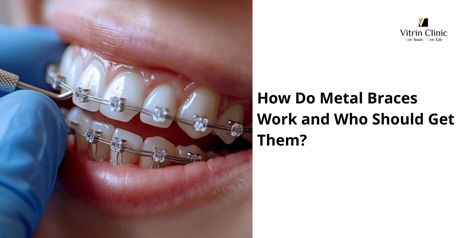 How Do Metal Braces Work and Who Should Get Them?